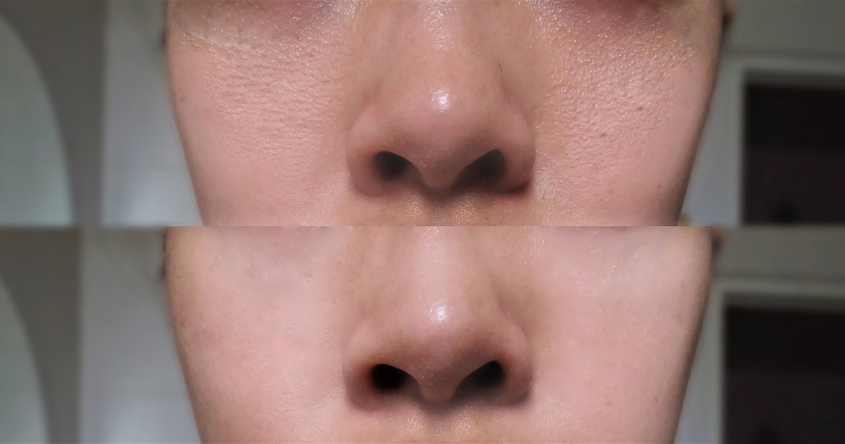 Ren Skincare Before And After